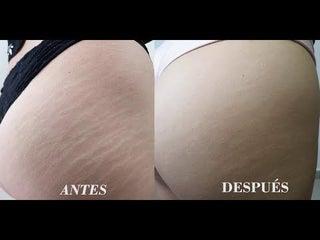 Tienes estrías? necesito modelo para tratarselas